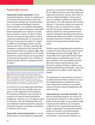 Taquicardia sinusal                                                   sinusal sin un estímulo fisiológico iden­ti­fi­ca­
                                                                      ble. Se deben descartar causas secun­da­rias de
Taquicardia sinusal apropiada. Es una                                 taqui­cardia sinusal en reposo, tales como la
taquicardia bastante común. Se produce por                            anemia, el hiperti­roi­dismo, el feocromoci­
un aumento del auto­ma­tismo a nivel del                              toma y la diabetes mellitus con disfunción
nodo sinusal mediado por estímulo simpá­                              autonómica. Han sido descritas dos variantes
tico. Es la respuesta fisiológica normal a                            clínicas: 1. Fre­cuencia cardíaca en reposo de
ciertos estímulos. Los estímulos fisiológicos                         100 lpm o más y 2. Aumento de la respu­
más comunes capaces de generar taquicardia                            esta de la frecuencia cardíaca a un mínimo
sinusal apropiada son el ejercicio, la ansie­                         esfuerzo (ejercicio). Estos pacientes tienen
dad, la anemia, el estrés, el dolor y la hipo­                        función ventricular izquierda preser­vada sin
volemia. Este tipo de taquicardia se acelera                          en­fer­medad subyacente car­día­ca. Frecuencias
y desa­ce­lera gradualmente. Se carac­te­riza al                      sinusales mayores de 200 lpm no son carac­
ECG por la presencia de ondas P y comple­                             terís­ticas de la taquicardia sinusal inapro­
jos QRS con morfología normal a una fre­                              piada.
cuencia entre 100 y 160 lpm, intervalos RR
constantes y disminución del intervalo PR                             Debido a que la despola­ri­za­ción auricular es
por el aumento del tono simpático (fig. 156).                         a través del nodo sinusal, las ondas P tienen
Usual­mente, no hay problema con la visua­li­                         morfología sinusal normal (fig. 156). El
zación de la onda P excepto en los pacientes                          mecanismo de la taquicardia sinusal ina­pro­
con frecuencias superiores a los 150 lpm en                           piada todavía es especulativo pero se cree
donde se puede obser­var superpuesta sobre                            que es debida a una anor­malidad primaria
la onda T.                                                            del nodo sinusal caracterizada por una
                                                                      fre­cuencia cardíaca intrínseca rápida y una
                                                                      hipersensibilidad beta adrenérgica, todo esto
                                                                      acentuado por un reflejo cardio-vagal dep­
                                                                      rimido.
Figura 156. Taquicardia sinusal. Note que se caracteriza por
ondas P de la misma morfología que preceden a cada complejo
QRS, la morfología es normal para la derivación V1, los intervalos    El tratamiento de estos pacien­tes incluye el
RR son constantes y el intervalo PR mide 120 mseg. La fre­
cuen­cia cardíaca es de 115 lpm. La diferencia entre la taquicardia
                                                                      acondicio­na­mien­to físico al ejercicio, el uso
sinu­sal apropiada y la inapropiada no se puede hacer por el trazo    de betablo­queadores y final­mente en los
electro­­cardio­gráfico sino por las características clínicas.
                                                                      casos re­frac­tarios la ablación con radiofre­
La frecuencia de esta taquicardia disminuye                           cuencia del nodo sinusal (modificación del
con el masaje del seno carotídeo pero rea­                            nodo sinusal).
pa­rece con la suspensión de la maniobra.
El tratamiento definitivo está orientado al                           Taquicardia por reentrada sinoatrial. Este
manejo de la causa de base (ansiolíticos,                             tipo de ta­qui­cardia surge de un circuito de
analgésicos, volumen, etc.). En algunos casos                         reentrada que involucra el nodo sinusal y el
es necesario el uso de betabloqueadores IV                            tejido atrial perinodal, lo que produce ondas
para disminuir transitoriamente la respuesta                          P prácticamente idén­ti­cas a las sinusales.
ventricular mientras se instaura el trata­mien­                       A diferencia de la taquicardia sinusal apro­
to definitivo de la causa.                                            piada e inapro­pia­da, la reen­trada sinoatrial
                                                                      puede ser iniciada y terminada abrupta­
Taquicardia sinusal inapropiada. Es un sín­                           mente por un estímulo atrial prematuro
drome clínico caracterizado por taqui­car­dia                         (extrasístole o extraestímulo) debido a su

9
	0
 