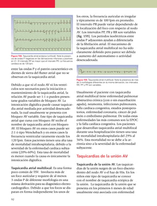 los otros, la frecuencia auricular es irregular
                                                                      y típicamente es de 100 lpm en prome­dio.
                                                                      El inter­valo PR puede variar depen­dien­do de
                                                                      la loca­lización del foco con respecto al nodo
                                                                      AV. Los inter­valos PP, PR y RR son variables
                                                                      (fig. 159). Los períodos isoe­léc­tri­cos entre
                                                                      ondas P adya­centes ayudan a dife­­ren­ciarla
                                                                      de la fibrilación atrial. El meca­nis­mo de
                                                                      la taquicardia atrial multifocal no ha sido
                                                                      clara­mente definido pero parece ser debida
Figura 158. Taquicardia atrial ectópica (unifocal). Note la presen­   a aumento del auto­ma­tismo o acti­vi­dad
cia de ondas P negativas en las derivaciones inferiores y positivas
en V1. El intervalo RP es mayor que el intervalo PR. La frecuencia    desenca­denada.
cardíaca es de 120 lpm.

entre las ondas P y el patrón característico en
dientes de sierra del flutter atrial que no se
observan en la taquicardia atrial.
                                                                      Figura 159. Taquicardia atrial multifocal. Note la presencia de más
                                                                      de 3 morfo­lo­gías diferentes en la misma derivación, los intervalos
Debido a que ni el nodo AV ni los ventrí­                             RR, PP y PR son variables.
cu­los son necesarios para la iniciación o
man­te­ni­miento de la taquicardia atrial, la                         Usualmente el paciente con taquicardia
re­la­ción AV puede ser 1:1 o pueden presen­                          atrial multifocal tiene enfermedad pulmonar
tarse grados variables de bloqueo AV. La                              obstructiva crónica (con o sin exacer­ba­ción
intoxi­ca­ción digitálica puede causar taquicar­                      aguda), neumo­nía, infecciones pulmonares,
dia atrial mediada por actividad desencade­                           falla cardía­ca congestiva, estados postope­ra­
nada, la cual usualmente se presenta con                              torios, en­fermedad coronaria, cáncer de pul­
bloqueo AV variable. Este tipo de taquicardia                         món o embolismo pulmonar. De todas estas
atrial que cursa con bloqueo AV recibe el                             en­fer­medades las más comunes son la EPOC
nombre de taquicardia atrial con bloqueo                              y la falla cardíaca congestiva. Los pacientes
AV. El bloqueo AV en estos casos puede ser                            que desarrollan taquicardia atrial multi­focal
2:1 ó tipo Wenckebach y en estos casos la                             durante una hospi­ta­lización tienen una tasa
fre­cuen­cia ventricular raramente excede los                         de mortalidad intrahos­pi­ta­laria del 29% al
120 lpm. Estos pacientes tienen una alta tasa                         56%. Esta morta­li­dad no se debe a la ar­
de mortalidad intrahospitalaria, debido a la                          ritmia sino a la severidad de la enfer­medad
severidad de la enfermedad cardíaca subya­                            subyacente.
cente (20%-60%). Esta tasa de mortalidad
es menor cuando la causa es únicamente la                             Taquicardias de la unión AV
intoxicación digitálica.
                                                                      Taquicardia de la unión AV. Las taquicar­
Taquicardia atrial multifocal. Es una forma                           dias de la unión surgen de un foco discreto
poco común de TSV. Involucra más de                                   den­tro del nodo AV o el haz de His. En los
un foco auricular y requiere de al menos                              niños este tipo de taquicardia se conoce
3 ondas P de diferente morfo­lo­gía en una                            con el nombre de taquicardia ectópica de
misma derivación para su diagnóstico electro­                         la unión. La taquicardia de la unión que se
car­diográfico. Debido a que los focos se dis­                        presenta en los primeros 6 meses de edad
paran en forma independiente los unos de                              usualmente está asociada con enfermedad

9
	2
 