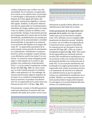 Taquicardias de complejos estrechos

cardíaca subyacente que conlleva una alta
mor­ta­li­dad. Por el contrario, la taqui­cardia
de la unión en los adul­tos tiene un pronósti­
co más benigno y típicamente se desarrolla                         Figura 161. Taquicardia de la unión. Note la presencia de disoci­
después de la fase aguda del infarto del                           ación AV (la fre­cuencia auricular es de 100 lpm y la ventricular es
                                                                   de 60 lpm).
miocardio, intoxicación digitálica o mio­car­
ditis aguda. También, es frecuente observar
                                                                   refractarios se puede realizar ablación con
este tipo de taquicardia en el postoperatorio
                                                                   radio­fre­cuencia del tejido de la unión.
inmediato de cirugía cardíaca tanto en niños
como en adultos y puede ser debida a trau­                         Forma permanente de la taquicardia reci­
ma perinodal. Aunque el me­canis­mo preciso                        procante de la unión. Este tipo de taqui­
de la taquicardia de la unión aún no ha sido                       car­dia cursa con una frecuencia cardía­ca
iden­ti­ficado, probable­mente sea causada por                     entre 120 y 200 lpm con un complejo QRS
un aumento de la automaticidad o actividad                         usual­mente de duración normal. También
desencadenada, lo que genera un aumento                            se conoce con el nombre de taqui­cardia de
en la iniciación del impulso en la región del                      Coumel (en honor a quien la describió).
nodo AV. La taquicardia automática de la                           Se caracteriza por ser incesante y tener un
unión tiende a tener período de calenta­mien­                      inter­valo RP largo (RP > PR) con ondas P
to y enfriamiento. Usualmente, la taqui­car­                       retrógradas (negativas) (fig. 162). Hace parte
dia de la unión es irregular y puede semejar                       de las taquicardias por reentrada atrioven­
a una fibrilación atrial si las ondas P no son                     tricular (AV) orto­dró­micas mediada por una
obvias. La activación atrial retrógrada puede                      vía accesoria oculta con con­ducción lenta y
seguir a cada impulso de la unión lo que                           decremental (similar a la conducción por el
produce una conducción ventri­culoatrial                           nodo AV). La vía accesoria usualmente está
(VA) 1:1 con las ondas P usualmente ocultas                        localizada en la región posteroseptal. Es una
dentro del QRS (fig. 160). En otras ocasio­                        taquicardia más común en personas jóvenes
nes, la onda P puede preceder al complejo                          y el trata­miento de elección es la abla­ción
QRS o estar posterior a él. Sin embar­go, de                       con radiofrecuencia ya que la supresión
manera más frecuente algunos impulsos de                           crónica con antiarrítmicos usual­mente no es
la unión no se conducen retrógra­da­men­te                         posible. Debido a su compor­ta­miento ince­
hacia la aurícula y se produce una disocia­                        sante puede producir taqui­car­dio­mio­patía,
ción VA. La taqui­car­dia de la unión tiene una                    la cual regresa a lo normal des­pués del trata­
frecuencia entre 60 y 120 lpm. (fig. 161).                         miento con radiofrecuencia.
El tratamiento consiste en betabloqueadores
orales para dis­minuir el aumento del auto­
matismo del tejido de la unión. En los casos




                                                                   Figura 162. Forma permanente de la taquicardia reciprocante de
                                                                   la unión (Taquicardia de Coumel). Note la presencia de ondas P
                                                                   negativas en las derivaciones inferiores y de V3 a V6. El intervalo
Figura 160. Taquicardia de la unión. Note la ausencia de ondas P   RP es mayor que el PR. La diferencia de esta taquicardia con la
(están ocultas dentro del complejo QRS). La frecuencia cardíaca    taquicardia atrial ectópica se hace mediante un estudio electrofi­
es de 70 lpm.                                                      siológico.

                                                                                                                                     93
 