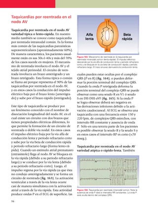 Taquicardias por reentrada en el
nodo AV

Taqui­cardia por reentrada en el nodo AV
variedad típica o lento-rápida. En nuestro
medio también se conoce como taqui­cardia
por reentrada intranodal común. Es la forma
más común de las taquicardias paroxísticas
supraventriculares (aproxima­damente 60%).
De manera característica, los pacientes usual­­
                                                   Figura 163. Mecanismo de reentrada en la taquicardia por
mente están en sus 30s ó 40s y más del 70%         reentrada intranodal común (lento-rápida). El impulso eléctrico
de los casos sucede en mujeres. El me­canis­       desciende por la vía alfa de conducción lenta y período refractario
                                                   corto y se bloquea en la vía beta de conducción rápida y período
mo de reentrada involucra el nodo AV y el          refractario largo. El trazo sinuoso demuestra la conducción lenta.
tejido atrial perinodal. El circuito de reen­
tra­da involucra un brazo anterógrado y un         cuales pueden estar ocultas por el complejo
brazo retró­grado. Esta forma típica o común       QRS (P en R) (fig. 164), o pueden defor­
se llama así porque representa el 90% de las       mar la porción terminal del complejo QRS.
taqui­cardias por reentrada en el nodo AV,         Cuando la onda P retró­gra­da deforma la
y en estos casos la conducción del impulso         porción terminal del comple­jo QRS se puede
eléctrico baja por el brazo lento (anteró­gra­     observar como una seudo R en V1 ó seudo
do) y sube por el brazo rápido (retrógrado).       S en DII-DIII-aVF (fig. 165). Si la onda P
                                                   se logra observar deberá ser negativa en
Este tipo de taquicardia se produce por            las derivaciones inferiores de­bi­do a la acti­
un fenómeno cono­cido con el nombre de             vación caudo­craneal. Al ECG se observa una
disociación longitudinal del nodo AV, en el        taquicardia con una frecuencia entre 150 y
cual existe un circuito con dos brazos que         220 lpm, de complejos QRS estrechos, con
tienen propiedades eléctricas diferentes, lo       intervalo RR constante y ausencia de onda
que permite la formación de un circuito de         P. Sólo en una tercera parte de los pa­cientes
reentrada o doble vía nodal. En estos casos        es posible observar la seudo R y la seudo S y
el impulso eléctrico baja por la vía alfa de       en estos casos el intervalo RP es corto (<70
conducción lenta y período refractario corto       mseg.).
y sube por la vía beta de conducción rápida
y período refractario largo (for­ma lento-rá­      Taquicardia por reentrada en el nodo AV
pida). Cuando un estímulo atrial prema­tu­sro      variedad atípica o rápido-lenta. También
(extrasístole) llega al nodo AV se bloquea en
la vía rápida (debido a su período refrac­ta­rio
largo) y se conduce por la vía lenta (debido
a su período refractario corto). Luego, el
impulso regresa por la vía rápida ya que ésta
no condujo anterógradamente y se forma un
circuito de reentrada (fig. 163). La activación
ventricular a través de la vía lenta ocurre
casi de manera simultánea con la activación
atrial a través de la vía rápida. Esta actividad   Figura 164. Taquicardia por reentrada intranodal común. Note la
                                                   ausencia de onda P clara e intervalos RR constantes. La onda P
produce ondas P en el ECG de superficie, las       está oculta dentro del complejo QRS.

9
	4
 