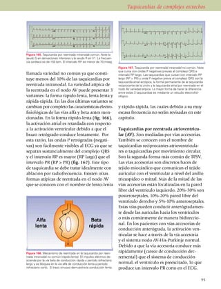 Taquicardias de complejos estrechos




Figura 165. Taquicardia por reentrada intranodal común. Note la
seudo S en derivaciones inferiores y la seudo R en V1. La fre­­­cuen­
cia cardíaca es de 150 lpm. El intervalo RP es menor de 70 mseg.
                                                                        Figura 167. Taquicardia por reentrada intranodal no común. Note
                                                                        que cursa con ondas P negativas previas al complejo QRS e
llamada variedad no común ya que consti­                                intervalo RP largo. Las taquicardias que cursan con intervalo RP
tu­ye menos del 10% de las taquicardias por                             largo (RP > PR) y onda P negativa previa al complejo QRS son la
                                                                        taquicardia atrial ectópica, la forma permanente de la taquicardia
reentrada intranodal. La variedad atípica de                            reciprocante de la unión y la taquicardia atrial por reentrada en el
la reentrada en el nodo AV puede presentar 3                            nodo AV variedad atípica. La mejor forma de hacer la diferencia
                                                                        entre estas 3 taqui­car­dias es mediante un estudio electrofisi­
variantes: la forma rápido-lenta, lenta-lenta y                         ológico.
rápida-rápida. En las dos últimas variantes se
cambian por completo las características elec­tro­                      y rápido-rápida, las cuales debido a su muy
fisiológicas de las vías alfa y beta antes men­                         escasa frecuencia no serán revisadas en este
cionadas. En la forma rápido-lenta (fig. 166),                          capítulo.
la activación atrial es retardada con respecto
a la activación ventricular debido a que el                             Taquicardias por reentrada atrioventricu­
brazo retrógrado conduce lentamente. Por                                lar (AV). Son mediadas por vías accesorias.
esta razón, las ondas P retrógradas (nega­ti­                           También se conocen con el nombre de
vas) son fácilmente visibles al ECG ya que se                           taquicardias reciprocantes atrioventricula­
separan sustancialmente del complejo QRS                                res o taquicardias por movimiento circular.
y el intervalo RP es mayor (RP largo) que el                            Son la segunda forma más común de TPSV.
intervalo PR (RP > PR) (fig. 167). Este tipo                            Las vías accesorias son discretos haces de
de taquicardia se debe tratar idealmente con                            tejido miocárdico que comunican el tejido
ablación por radiofrecuencia. Existen otras                             auricular con el ventricular a nivel del anillo
formas atípicas de reentrada en el nodo AV                              tricus­pídeo o mitral. Más de la mitad de las
que se conocen con el nombre de lento-lenta                             vías accesorias están localizadas en la pared
                                                                        libre del ventrículo izquierdo, 20%-30% son
                                                                        posteroseptales, 10%-20% pared libre del
                                                                        ventrículo derecho y 5%-10% antero­sep­tales.
                                                                        Estas vías pueden con­du­cir anterógra­damen­
                                                                        te desde las aurículas hacia los ventrículos
                                                                        o más comúnmente de manera bidireccio­
                                                                        nal. En los pacientes con vías accesorias de
                                                                        con­­ducción anterógrada, la activa­ción ven­
                                                                        tricular se hace a través de la vía accesoria
                                                                        y el sistema nodo AV-His-Purkinje normal.
                                                                        Debido a que la vía accesoria conduce más
Figura 166. Mecanismo de reentrada en la taquicardia por reen­
                                                                        rápidamente (carece de con­ducción dec­
trada intranodal no común (rápido-lenta). El impulso eléctrico de­      remental) que el sistema de conducción
sciende por la vía beta de conducción rápida y período refractario
largo y se bloquea en la vía alfa de conducción lenta y período         normal, el ven­trículo es preexcitado, lo que
refractario corto. El trazo sinuoso demuestra la conducción lenta.      produce un intervalo PR corto en el ECG.

                                                                                                                                         95
 