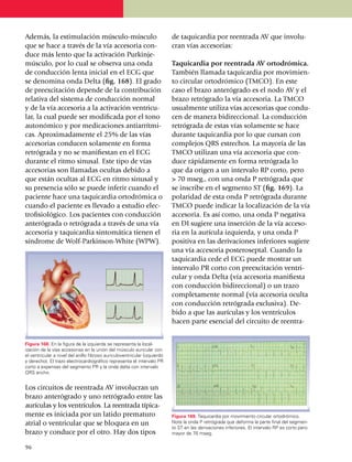 Además, la esti­mu­lación músculo-músculo                                  de taquicardia por reentrada AV que invo­lu­
que se hace a través de la vía accesoria con­                              cran vías accesorias:
duce más lento que la activación Purkinje-
músculo, por lo cual se observa una onda                                   Taquicardia por reentrada AV ortodrómica.
de conducción lenta inicial en el ECG que                                  También llamada taquicardia por movi­mien­
se deno­mina onda Delta (fig. 168). El grado                               to circular ortodrómico (TMCO). En este
de preexcitación depende de la contribución                                caso el brazo ante­ró­grado es el nodo AV y el
relativa del sistema de conducción normal                                  brazo retrógrado la vía accesoria. La TMCO
y de la vía accesoria a la acti­va­ción ventricu­                          usualmente utiliza vías accesorias que con­du­
lar, la cual puede ser modificada por el tono                              cen de manera bidireccional. La con­ducción
autonómico y por medica­cio­nes antiarrítmi­                               retrógrada de estas vías solamente se hace
cas. Aproxi­ma­damente el 25% de las vías                                  durante taquicardia por lo que cursan con
accesorias conducen solamente en forma                                     complejos QRS estrechos. La mayoría de las
retrógrada y no se ma­nifiestan en el ECG                                  TMCO utilizan una vía accesoria que con­
durante el ritmo sinusal. Este tipo de vías                                duce rápidamente en forma retrógrada lo
accesorias son llamadas ocultas debido a                                   que da origen a un intervalo RP corto, pero
que están ocultas al ECG en ritmo sinusal y                                > 70 mseg., con una onda P retró­gra­da que
su presencia sólo se puede inferir cuando el                               se inscribe en el seg­men­to ST (fig. 169). La
paciente hace una taquicardia ortodrómica o                                polaridad de esta onda P retrógrada durante
cuando el pa­ciente es llevado a estudio elec­                             TMCO puede indicar la locali­zación de la vía
trofisiológico. Los pacientes con conducción                               accesoria. Es así como, una onda P negativa
anterógrada o retrógrada a tra­vés de una vía                              en DI sugiere una inserción de la vía acce­so­
accesoria y taquicardia sintomática tienen el                              ria en la aurícula izquierda, y una onda P
síndrome de Wolf-Parkinson-White (WPW).                                    positiva en las derivaciones inferiores sugiere
                                                                           una vía accesoria post­e­roseptal. Cuando la
                                                                           taquicardia cede el ECG puede mostrar un
                                                                           intervalo PR corto con preexci­tación ventri­
                                                                           cular y onda Delta (vía accesoria manifiesta
                                                                           con conducción bidi­reccional) o un trazo
                                                                           completamente normal (vía accesoria oculta
                                                                           con con­ducción retrógrada exclusiva). De­
                                                                           bido a que las aurículas y los ventrí­cu­los
                                                                           hacen parte esencial del circuito de reen­tra­


Figura 168. En la figura de la izquierda se representa la local­
ización de la vías accesorias en la unión del músculo auricular con
el ventricular a nivel del anillo fibroso auriculoventricular (izquierdo
y derecho). El trazo electrocardiográfico representa el intervalo PR
corto a expen­sas del segmento PR y la onda delta con intervalo
QRS ancho.


Los circuitos de reentrada AV involucran un
brazo anteró­grado y uno retrógrado entre las
aurículas y los ventrículos. La reentrada típi­ca­
mente es iniciada por un latido prema­turo                                 Figura 169. Taquicardia por movimiento circular ortodrómico.
atrial o ventricular que se bloquea en un                                  Note la onda P retrógrada que deforma la parte final del segmen­
                                                                           to ST en las derivaciones inferiores. El intervalo RP es corto pero
brazo y conduce por el otro. Hay dos tipos                                 mayor de 70 mseg.

9
	6
 