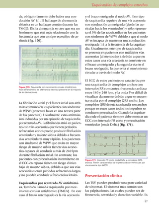 Taquicardias de complejos estrechos

da, obliga­to­riamente debe haber una con­                         y el brazo retrógrado el nodo AV. Este tipo
ducción AV 1:1. El hallazgo de alternancia                         de taquicardia requiere de una vía accesoria
eléctrica es un hallazgo común durante las                         con conducción anterógrada (desde las au­
TMCO. Dicha alternancia se cree que sea un                         rículas hacia los ventrículos) y sólo represen­
fenómeno que está más relacionado con la                           ta el 5% de las taqui­car­dias en los pacientes
frecuencia que con un tipo específico de ar­                       con síndrome de WPW debido a que el nodo
ritmia (fig. 170).                                                 AV es incapaz de mantener una conducción
                                                                   retrógrada 1:1 a la fre­cuen­cia de la taquicar­
                                                                   dia. Usual­men­te, este tipo de taquicardia
                                                                   se presenta en pacientes con múltiples vías
                                                                   accesorias (al menos dos), debido a que en
                                                                   estos casos una vía accesoria se convierte en
                                                                   el brazo anteró­grado y la segunda vía en el
                                                                   brazo retró­gra­do, lo que evita el movimiento
                                                                   circular a través del nodo AV.

                                                                   El ECG de estos pacientes se caracteriza por
                                                                   una taquicardia de complejos anchos con
Figura 170. Taquicardia por movimiento circular ortodrómico.
Note el fenómeno de alternancia eléctrica presente en la mayoría   intervalos RR constantes, frecuencia cardíaca
de las derivaciones.                                               entre 140 y 240 lpm, y la onda P es difícil de
                                                                   visualizar claramente debido a que se encuen­
                                                                   tra oculta por el complejo QRS ancho. Los
La fibrilación atrial y el flutter atrial son arrit­
                                                                   complejos QRS de esta taqui­car­dia son anchos
mias comunes en los pacientes con síndrome
                                                                   porque en estos casos todos los impulsos se
de WPW (presentes hasta en una tercera parte
                                                                   conducen preexcitados. Cuando la taquicar­
de los pacientes). Usualmente, estas arritmias
                                                                   dia cede el paciente siempre debe mostrar un
son inducidas por un episo­dio de taquicardia
                                                                   ECG con inter­valo PR corto y preexcitación
por reentrada AV. La fi­bri­lación atrial en pa­cien­
                                                                   ventricular (onda Delta) (fig. 171).
tes con vías accesorias que tienen perío­dos
refractarios cortos puede producir fibri­la­ción
ventricular y muerte sú­bita debido a frecuen­
cias ventri­cu­la­res muy rá­pidas. Los pacientes
con sín­dro­me de WPW que están en mayor
riesgo de muerte súbita tienen vías acceso­
rias capaces de conducir a más de 240 lpm
durante fibri­lación atrial. En contraste, los
pacientes con preexcitación intermitente en                        Figura 171. Intervalo PR corto, onda Delta y complejos QRS
el ECG en reposo tienen un riesgo clínico                          anchos. Patrón característico de la preexcitación ventricular por
                                                                   vía accesoria tipo WPW.
bajo de muerte súbita, debido a que sus vías
acceso­rias tienen períodos refractarios largos
y no pueden conducir a frecuencias letales.                        Presentación clínica
Taquicardias por reentrada AV antidrómi­                           Las TSV pueden producir una gran variedad
ca. También llamada taquicardia por mov­                           de síntomas. El síntoma más común son
imiento circular antidrómico (TMCA). En este                       las palpitaciones, las cuales pue­den ser de
caso el brazo anteró­gra­do es la vía accesoria                    fre­cuencia, severidad y duración variable. Es

                                                                                                                                   97
 