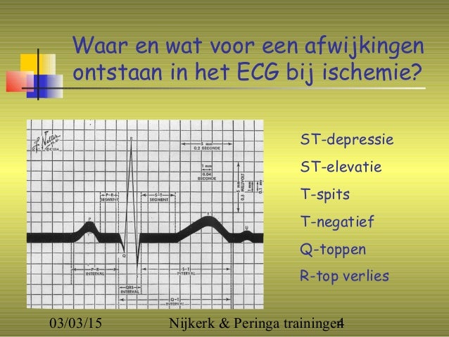 Electrocardiografische afwijkingen bij het myocardinfarct