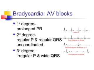 Bradycardia- AV blocks
 1st
degree-
prolonged PR
 2nd
degree-
regular P & regular QRS,
uncoordinated
 3rd
degree-
irregular P & wide QRS
 