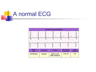 A normal ECG
 