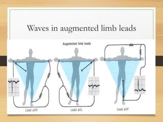 Waves in augmented limb leads
 