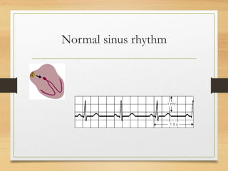 Sinus Rhy Electrocardiogram | PPTX