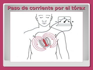 Paso de corriente por el tórax 
