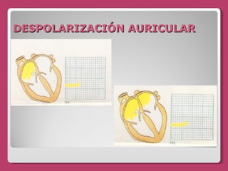 DESPOLARIZACIÓN AURICULAR 