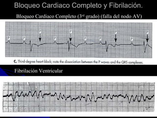 Bloqueo Cardiaco Completo y Fibrilación. Bloqueo Cardiaco Completo (3 rd  grado) (falla del nodo AV) Fibrilación Ventricular 