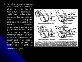 En algunas circunstancias otras áreas del corazón adquieren la función del nódulo S.A. y comienzan a enviar sus propias señales eléctricas; los impulsos de estos marcapasos anormales no siguen la ruta eléctrica anormal, conduciendo a una arritmia que altera la manera normal en la cual se contrae el corazón; y algunos de estos marcapasos son capaces de enviar cientos de señales por minuto produciendo contracciones cardiacas sumamente rápidas.   