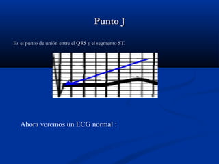 Punto J

Es el punto de unión entre el QRS y el segmento ST.




   Ahora veremos un ECG normal :
 