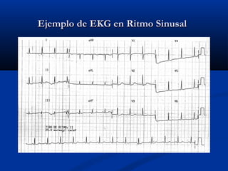 Ejemplo de EKG en Ritmo Sinusal
 