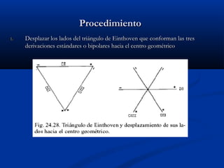 Procedimiento
1.   Desplazar los lados del triángulo de Einthoven que conforman las tres
     derivaciones estándares o bipolares hacia el centro geométrico
 