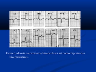 Existen además crecimientos biauriculares así como hipertrofias
  biventriculares .
 