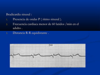 Bradicardia sinusal :
1.   Presencia de ondas P ( ritmo sinusal ).
2.   Frecuencia cardiaca menor de 60 latidos /min en el
     adulto .
3.   Distancia R-R equidistante .
 