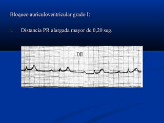 Bloqueo auriculoventricular grado I:

1.   Distancia PR alargada mayor de 0,20 seg.
 