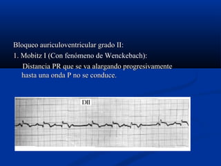 Bloqueo auriculoventricular grado II:
1. Mobitz I (Con fenómeno de Wenckebach):
            (
   Distancia PR que se va alargando progresivamente
   hasta una onda P no se conduce.
 