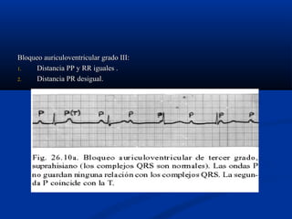 Bloqueo auriculoventricular grado III:
1.   Distancia PP y RR iguales .
2.   Distancia PR desigual.
 