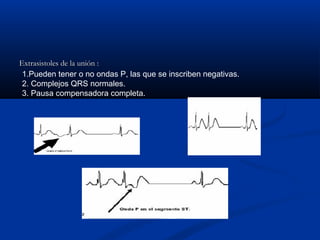 Extrasistoles de la unión :
 1.Pueden tener o no ondas P, las que se inscriben negativas.
 2. Complejos QRS normales.
 3. Pausa compensadora completa.
 