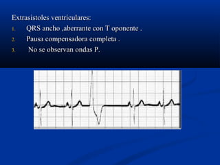 Extrasistoles ventriculares:
1.   QRS ancho ,aberrante con T oponente .
2.   Pausa compensadora completa .
3.   No se observan ondas P.
 