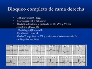 Bloqueo completo de rama derecha
  •   QRS mayor de 0,12seg.
  •    Morfología rsR o rSR en V1
  •    Onda S redondeada y profunda en DI, aVL y V6 con
      complejos qRs o qRS.
  •    Morfología QR en aVR.
  •    Eje eléctrico normal.
  •    Ondas T negativas en V1 y positivas en V6 en ausencia de
      cardiopatías asociadas.
 