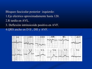 Bloqueo fascicular posterior izquierdo:
1.Eje eléctrico aproximadamente hasta 120.
2.R tardía en AVL.
3. Deflexión intrinsicoide positiva en AVF.
4.QRS ancho en D II , DII y AVF.
 