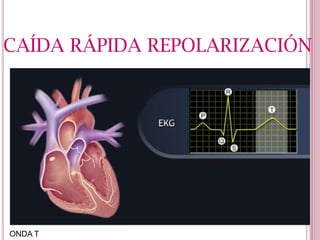 CAÍDA RÁPIDA REPOLARIZACIÓN

ONDA T

 