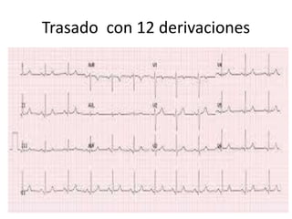 Trasado con 12 derivaciones
 