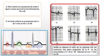 2. Otro criterio es la presencia de onda S
igual o mayor que la R en las derivaciones
V5 o V6
3. Un tercer criterio es la presencia de S >
de 7 mm en V5 o en V6
Arriba se observa el trazo de un paciente con cor
pulmonar, hay pobre progresión de la R en las
precordiales y S > R en V5. Además la S es > 7mm
en V5
 