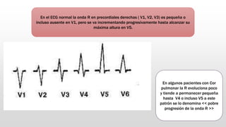 En el ECG normal la onda R en precordiales derechas ( V1, V2, V3) es pequeña o
incluso ausente en V1, pero se va incrementando progresivamente hasta alcanzar su
máxima altura en V5.
En algunos pacientes con Cor
pulmonar la R evoluciona poco
y tiende a permanecer pequeña
hasta V4 o incluso V5 a este
patrón se lo denomina << pobre
progresión de la onda R >>
 