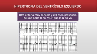 HIPERTROFIA DEL VENTRÍCULO IZQUIERDO
Otro criterio muy sencillo y útil es la presencia
de una onda R en V6 > que la R en V5
 