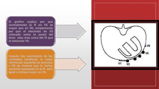 El grafico explica por que
normalmente la R en V5 es
mayor que en V6; simplemente
por que el electrodo de V5
colocado sobre la pared del
tórax esta mas cerca del VI que
el electrodo V6.
Cuando hay crecimiento de las
cavidades cardiacas, la masa
ventricular izquierda se acercara
a V6 de manera que la fuerza
vectorial expresada en la R será
igual o incluso mayor en V6.
 