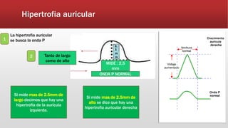 Hipertrofia auricular
La hipertrofia auricular
se busca la onda P
ONDA P NORMAL
MIDE : 2,5
mm
Tanto de largo
como de alto
1
2
Si mide mas de 2.5mm de
largo decimos que hay una
hipertrofia de la aurícula
izquierda.
Si mide mas de 2.5mm de
alto se dice que hay una
hipertrofia auricular derecha
 