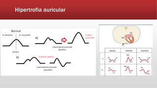 Hipertrofia auricular
 