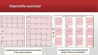 Sin embargo téngase en cuenta que
pueden haber ondas P melladas que
miden menos de 2,5 mm lo cual es un
hallazgo normal.
La hipertrofia de la aurícula derecha da ondas
P muy altas o picudas.
La hipertrofia en la aurícula izquierda
tiende a formar una melladura.
Hipertrofia auricular
 