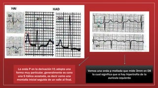 Vemos una onda p mellada que mide 3mm en DII
lo cual significa que si hay hipertrofia de la
aurícula izquierda
La onda P en la derivación V1 adopta una
forma muy particular, generalmente es cono
una S itálica acostada, es decir como una
montalla inicial seguida de un valle al final.
 