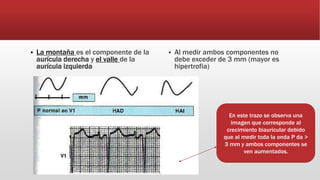  La montaña es el componente de la
aurícula derecha y el valle de la
aurícula izquierda
 Al medir ambos componentes no
debe exceder de 3 mm (mayor es
hipertrofia)
En este trazo se observa una
imagen que corresponde al
crecimiento biauricular debido
que al medir toda la onda P da >
3 mm y ambos componentes se
ven aumentados.
 