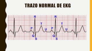 TRAZO NORMAL DE EKG
 