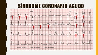 SÍNDROME CORONARIO AGUDO
 