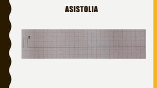 ASISTOLIA
 
