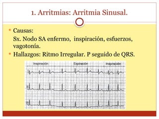 1. Arritmias: Arritmia Sinusal.
 Causas:
Sx. Nodo SA enfermo, inspiración, esfuerzos,
vagotonía.
 Hallazgos: Ritmo Irregular. P seguido de QRS.
 