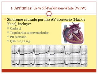 1. Arritmias: Sx Wolf-Parkinson-White (WPW)
 Síndrome causado por haz AV accesorio (Haz de
Kent), incluye:
 Ondas Δ
 Taquicardia supraventricular.
 PR acortado.
 QRS > 0,12 seg
 