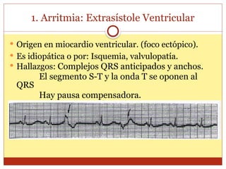 1. Arritmia: Extrasístole Ventricular
 Origen en miocardio ventricular. (foco ectópico).
 Es idiopática o por: Isquemia, valvulopatía.
 Hallazgos: Complejos QRS anticipados y anchos.
El segmento S-T y la onda T se oponen al
QRS
Hay pausa compensadora.
 