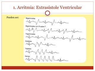 1. Arritmia: Extrasístole Ventricular
Pueden ser:
 