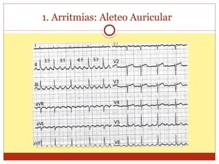 1. Arritmias: Aleteo Auricular
 