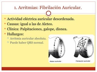 1. Arritmias: Fibrilación Auricular.
 Actividad eléctrica auricular desordenada.
 Causas: igual a las de Aleteo.
 Clínica: Palpitaciones, galope, disnea.
 Hallazgos:
 Arritmia auricular absoluta.
 Puede haber QRS normal.
 