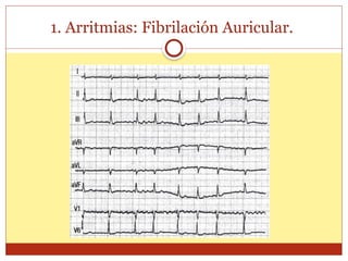 1. Arritmias: Fibrilación Auricular.
 