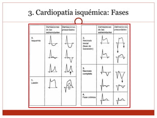 3. Cardiopatía isquémica: Fases
 